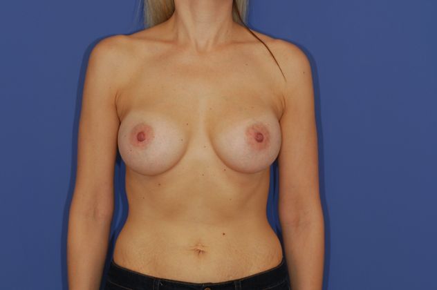 Breast Augmentation - Case 23 - After