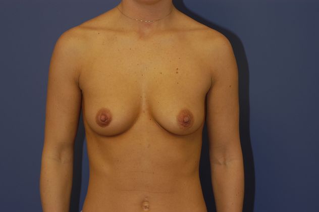 Breast Augmentation Patient Photo - Case 24 - before view-