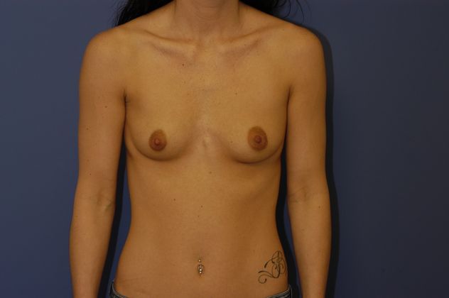 Breast Augmentation Patient Photo - Case 27 - before view-