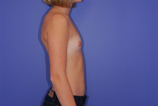 Breast Augmentation Patient Photo - Case 29 - before view-2