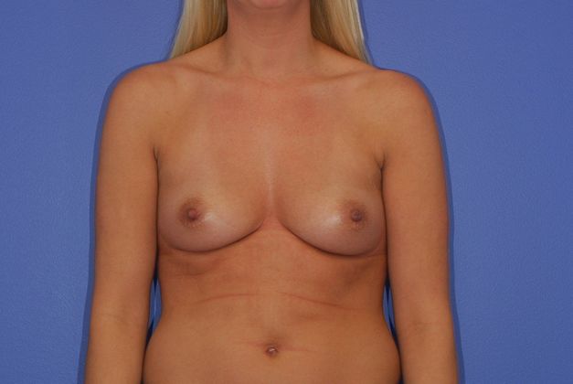Breast Augmentation Patient Photo - Case 30 - before view-0