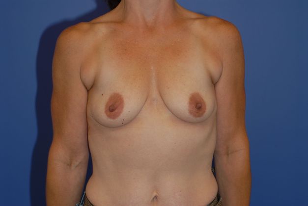 Breast Augmentation - Case 31 - Before