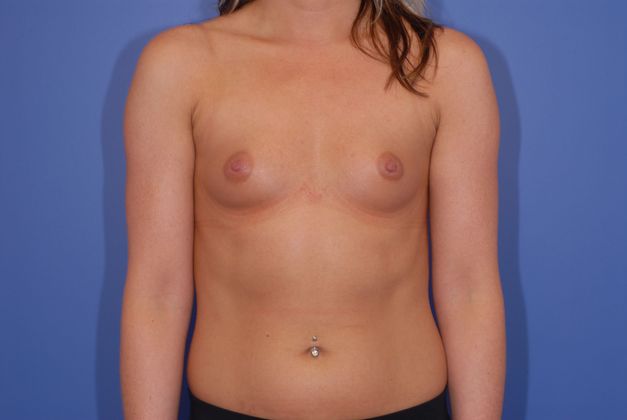Breast Augmentation - Case 32 - Before