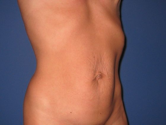 Abdominoplasty Patient Photo - Case 11 - before view-1