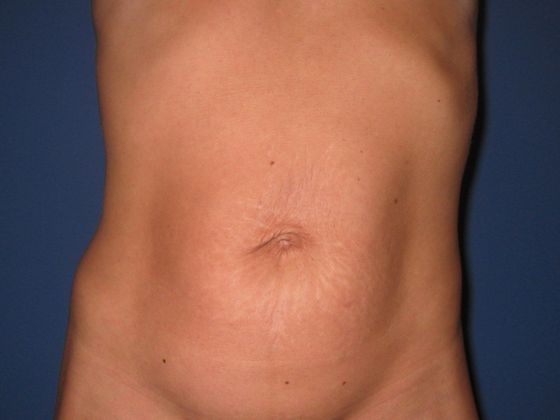 Abdominoplasty Patient Photo - Case 11 - before view-