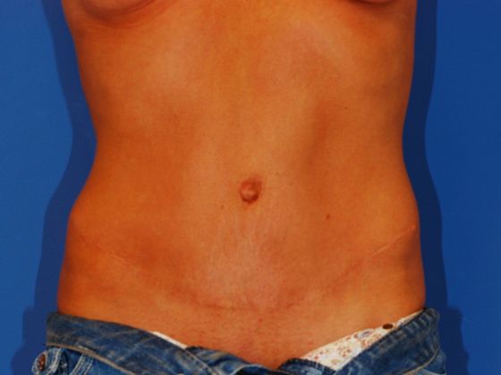 Abdominoplasty Patient Photo - Case 11 - after view
