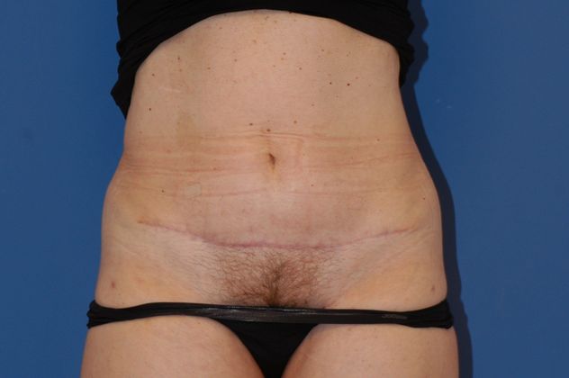 Abdominoplasty Patient Photo - Case 12 - after view