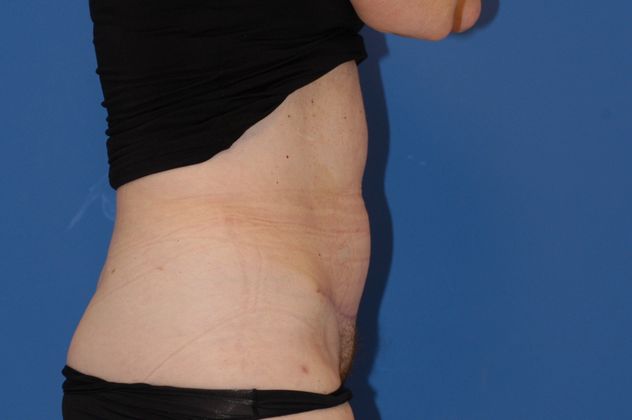 Abdominoplasty Patient Photo - Case 12 - after view-2