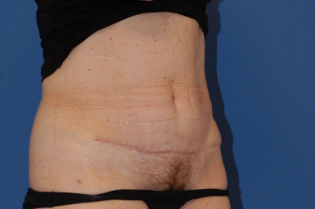 Abdominoplasty Patient Photo - Case 12 - after view-1
