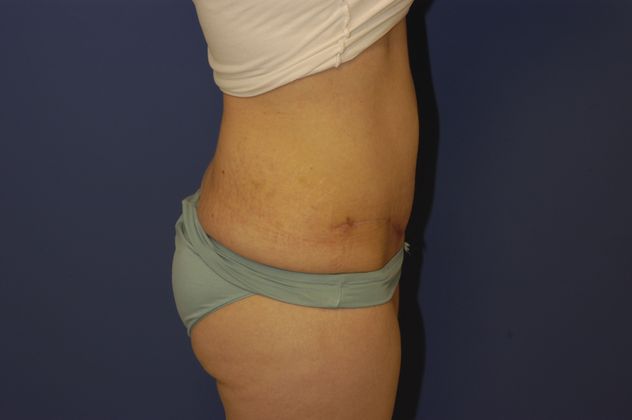 Abdominoplasty Patient Photo - Case 13 - after view-2