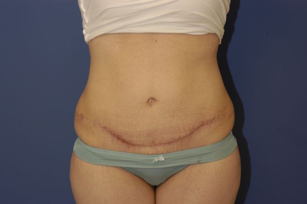 Abdominoplasty Patient Photo - Case 13 - after view