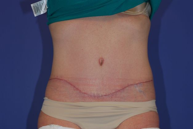Abdominoplasty Patient Photo - Case 14 - after view