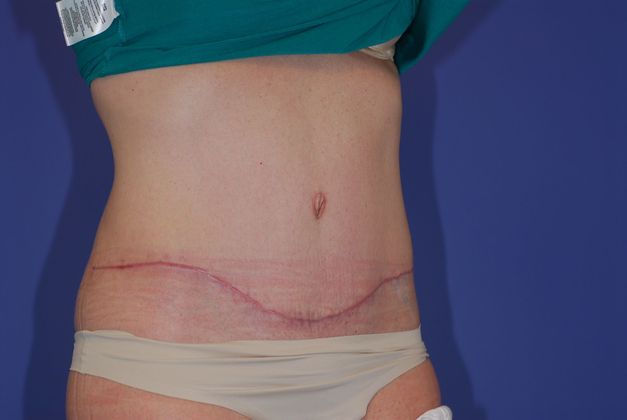 Abdominoplasty Patient Photo - Case 14 - after view-1