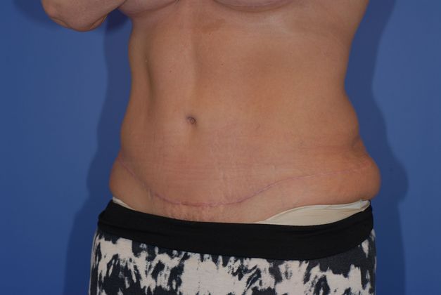 Abdominoplasty Patient Photo - Case 15 - after view-1