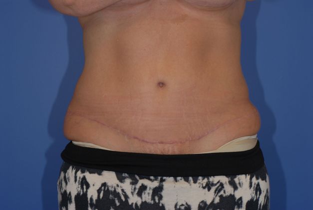 Abdominoplasty Patient Photo - Case 15 - after view