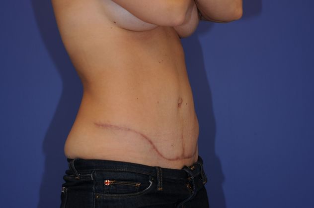 Abdominoplasty Patient Photo - Case 16 - after view-1