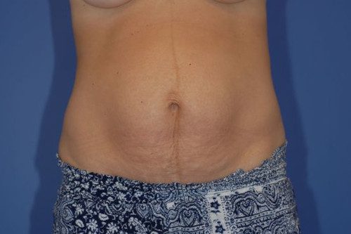 Abdominoplasty - Case 16 - Before