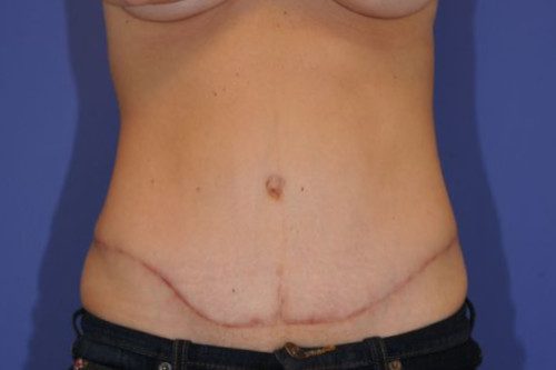Abdominoplasty Patient Photo - Case 16 - after view