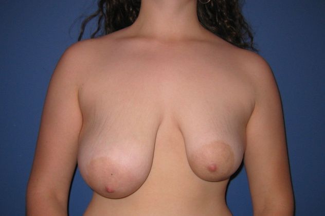 Breast Asymmetry Patient Photo - Case 11 - before view-0