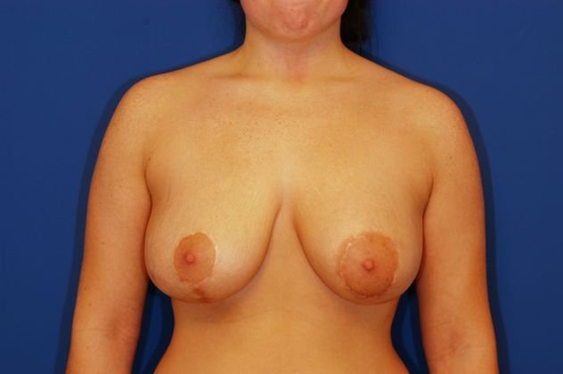 Breast Asymmetry - Case 11 - After