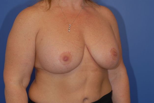 Mastopexy Patient Photo - Case 13 - after view-1