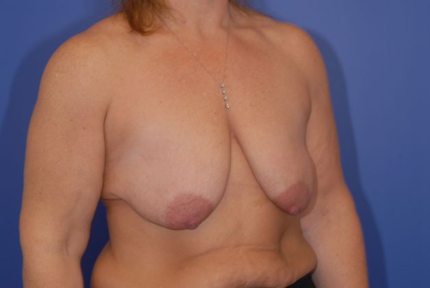 Mastopexy Patient Photo - Case 13 - before view-1