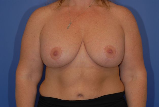 Mastopexy - Case 13 - After