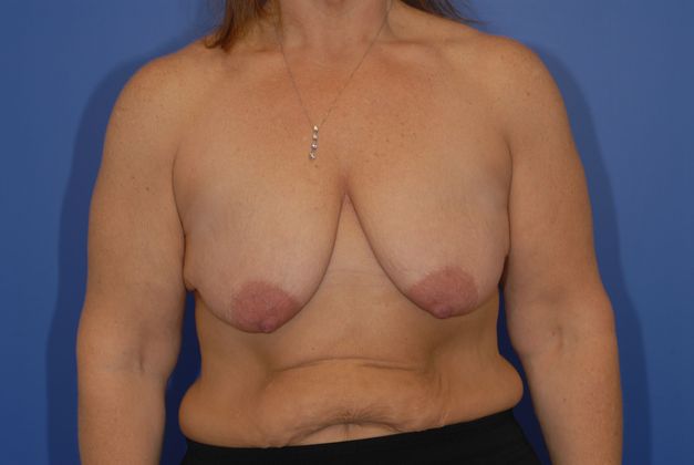 Mastopexy Patient Photo - Case 13 - before view-0
