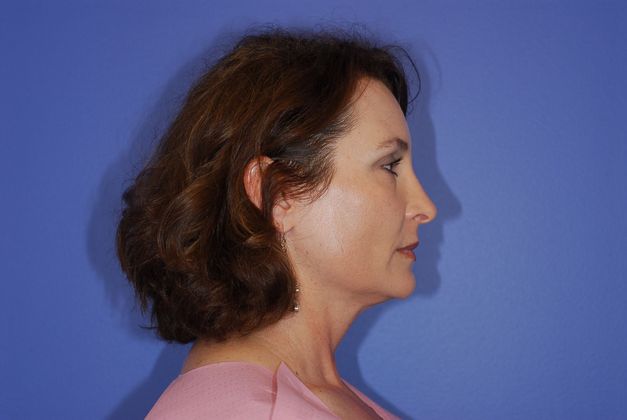 Rhinoplasty Patient Photo - Case 13 - after view