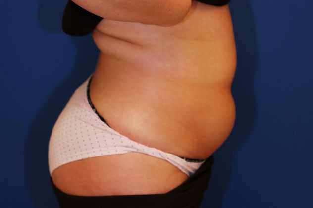 Liposuction Patient Photo - Case 11 - before view-2