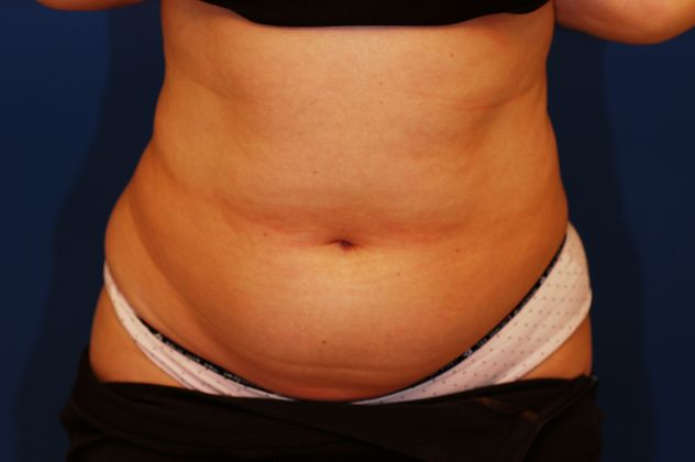 Liposuction - Case 11 - Before