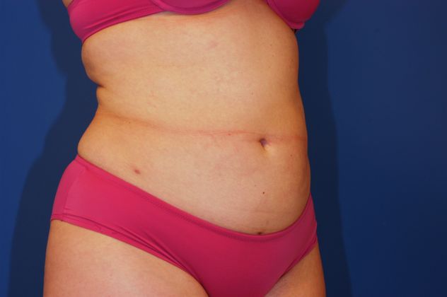 Liposuction Patient Photo - Case 11 - after view-1