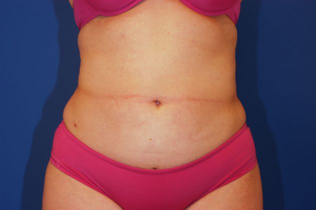 Liposuction - Case 11 - After
