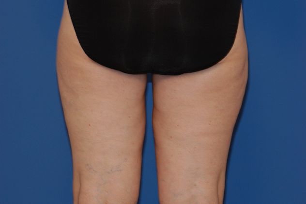Liposuction Patient Photo - Case 13 - after view-1