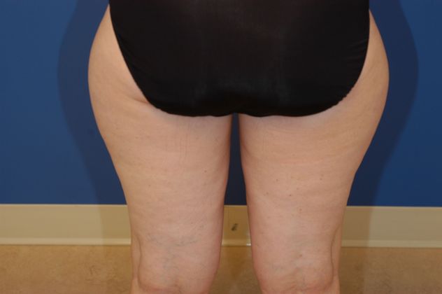 Liposuction Patient Photo - Case 13 - before view-1