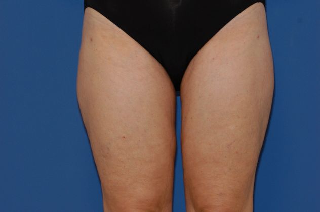 Liposuction - Case 13 - After