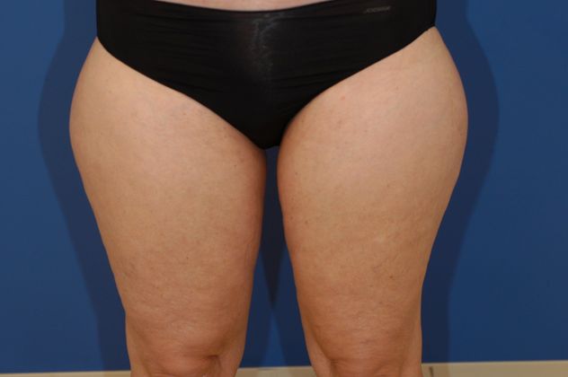 Liposuction - Case 13 - Before