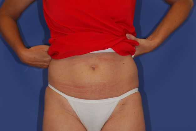 Liposuction Patient Photo - Case 14 - before view-