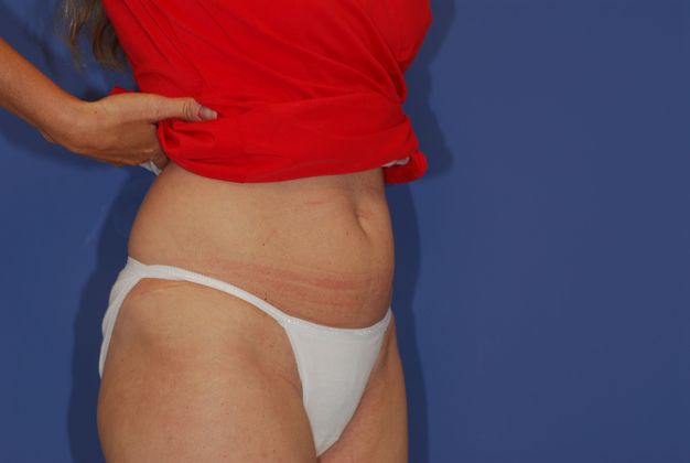 Liposuction Patient Photo - Case 14 - before view-1
