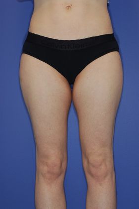 Liposuction - Case 15 - Before