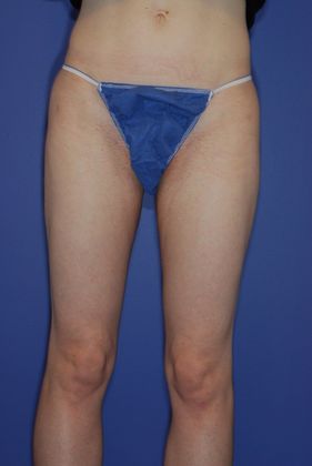 Liposuction - Case 15 - After