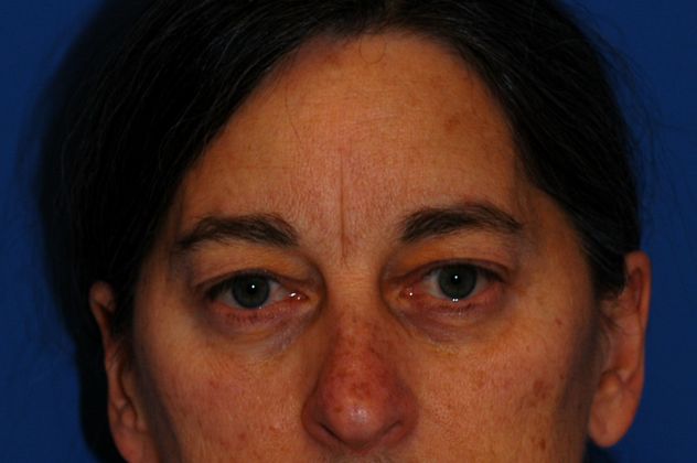 Eyelid Surgery Patient Photo - Case 11 - before view-