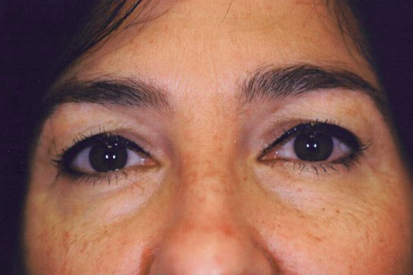 Eyelid Surgery - Case 12 - Before