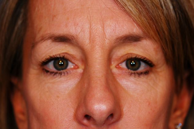 Eyelid Surgery - Case 14 - Before