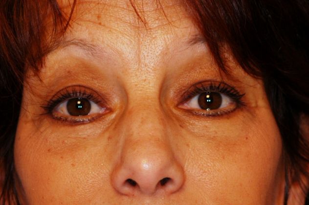 Eyelid Surgery Patient Photo - Case 15 - after view-0