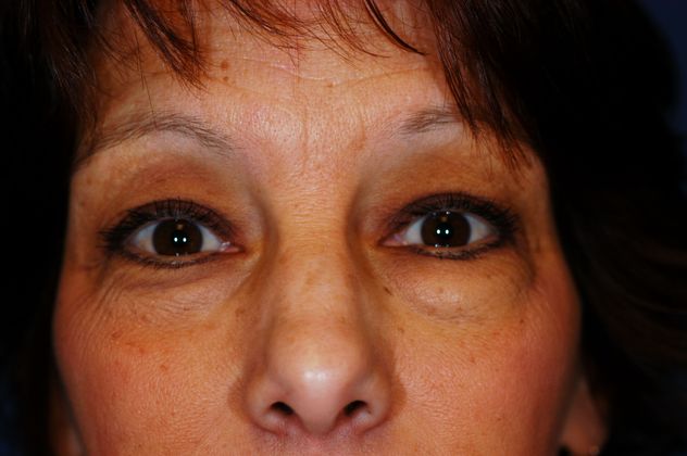 Eyelid Surgery Patient Photo - Case 15 - before view-