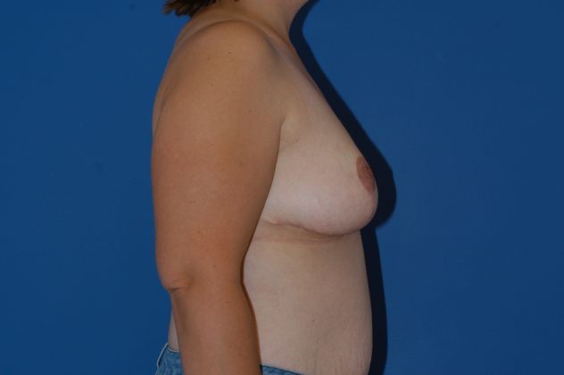 Breast Reduction Patient Photo - Case 12 - after view-2