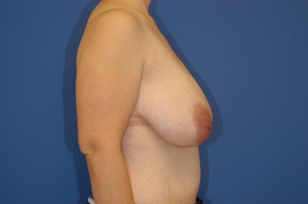 Breast Reduction Patient Photo - Case 12 - before view-2