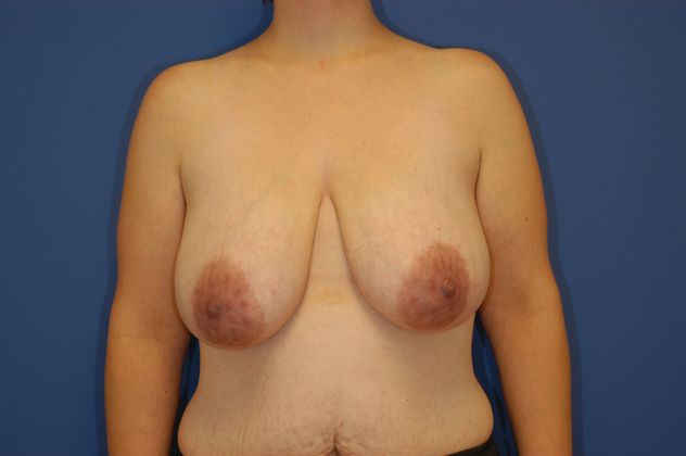 Breast Reduction - Case 12 - Before