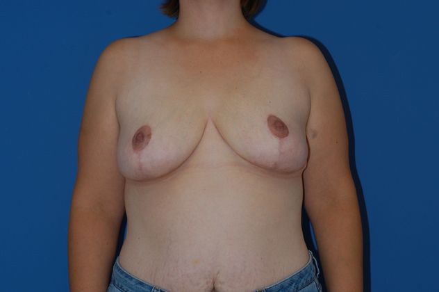 Breast Reduction Patient Photo - Case 12 - after view